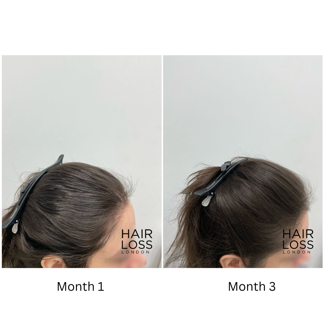 stress-related hair shedding