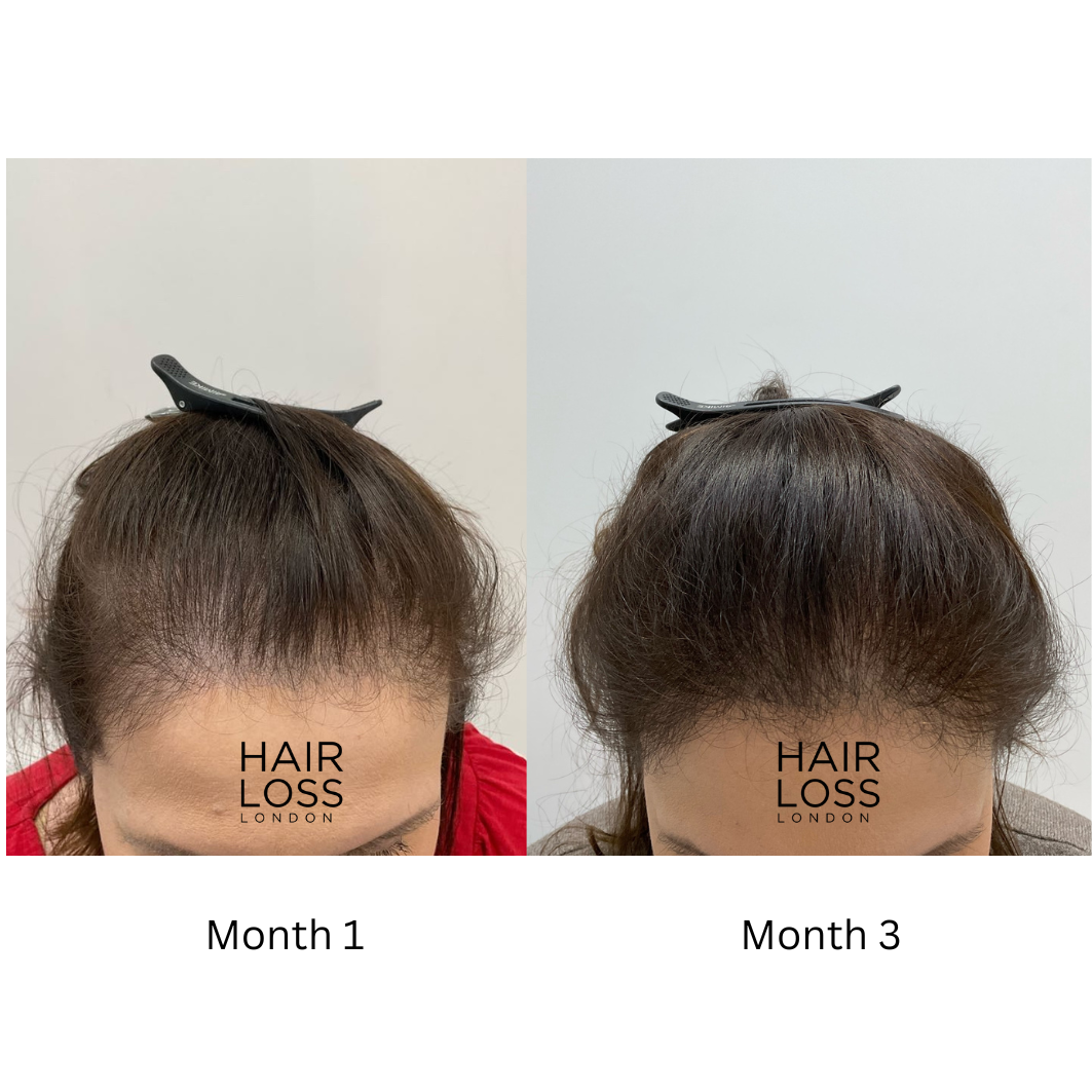 chronic telogen effluvium women