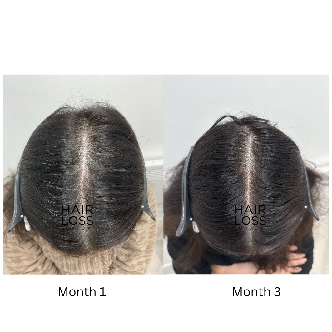 female pattern hair loss causes and diagnosis