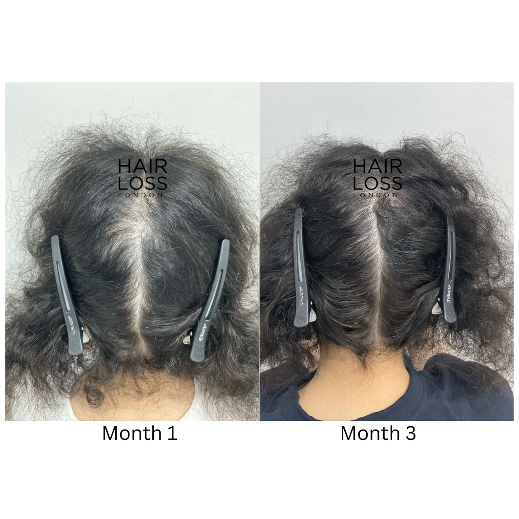 diffuse thinning crown women