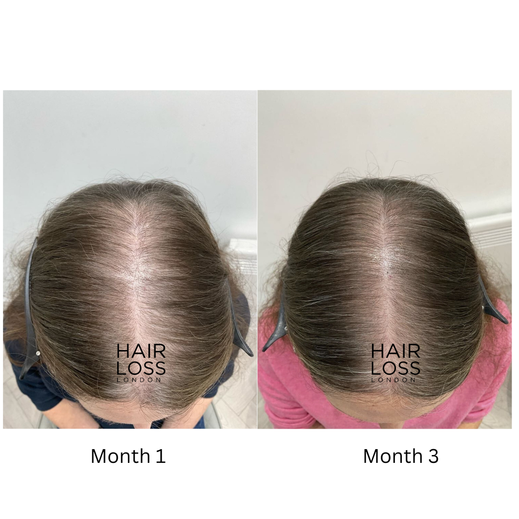 female pattern hair loss PCOS