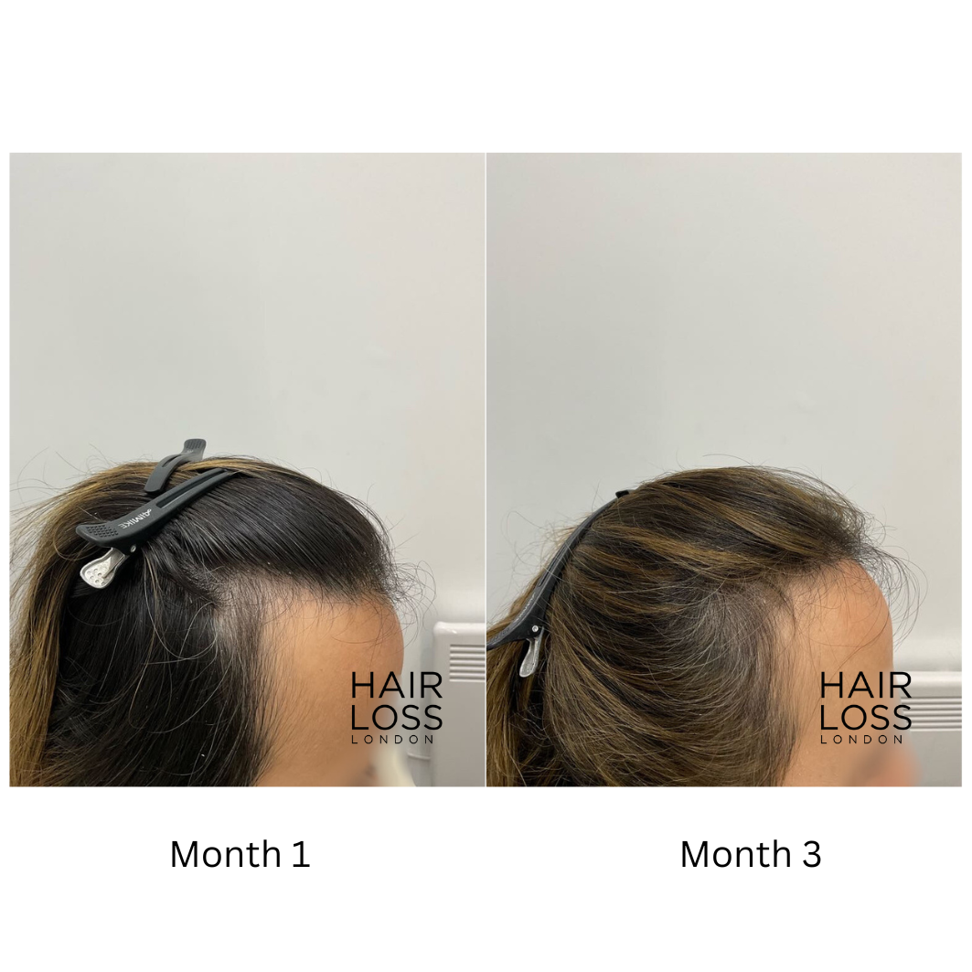 postpartum hair shedding timeline