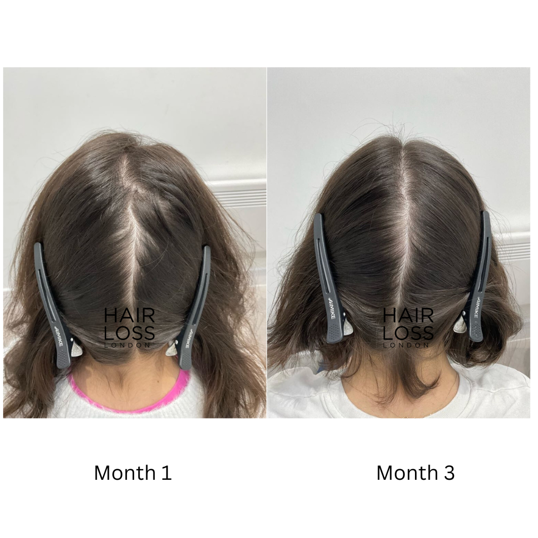 platelet-rich plasma PRP hair restoration