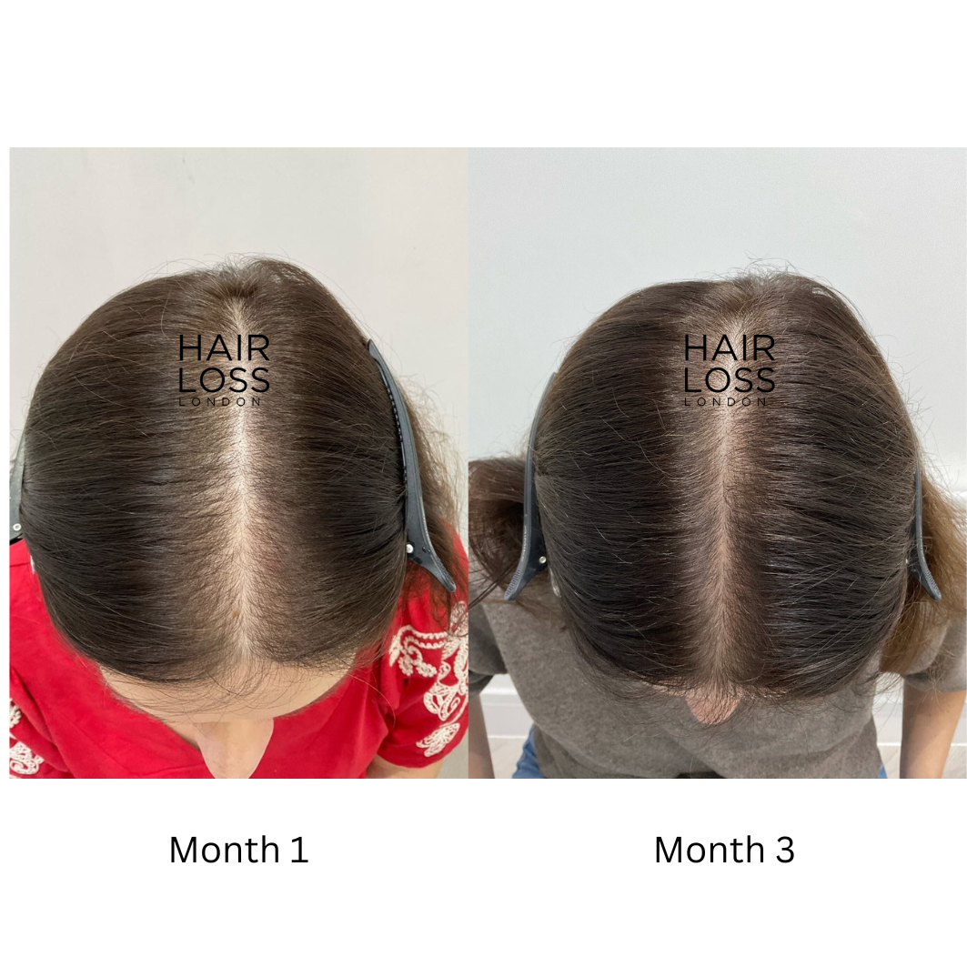 androgenic alopecia PCOS women