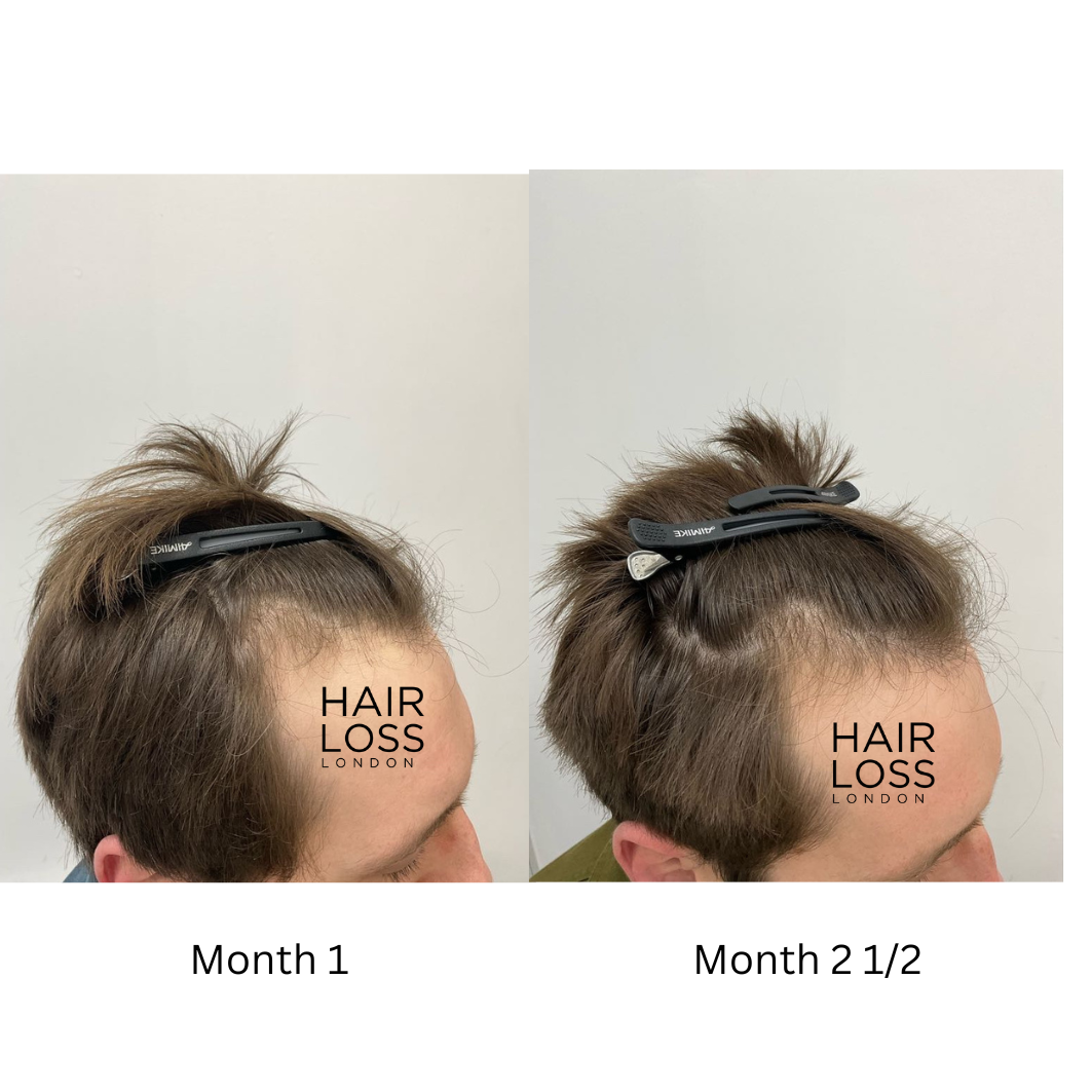 topical minoxidil male