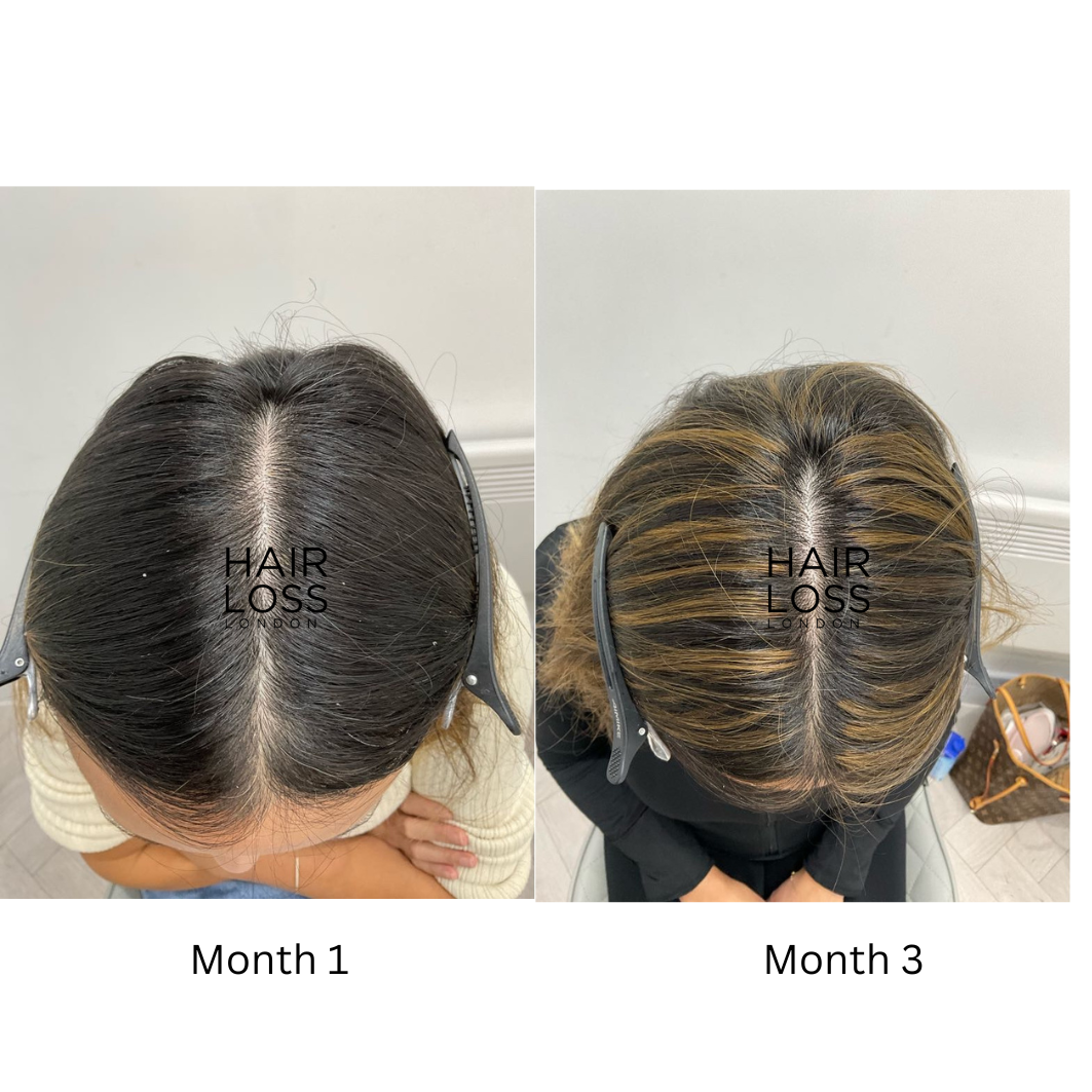 hormonal hair loss in women PCOS thyroid