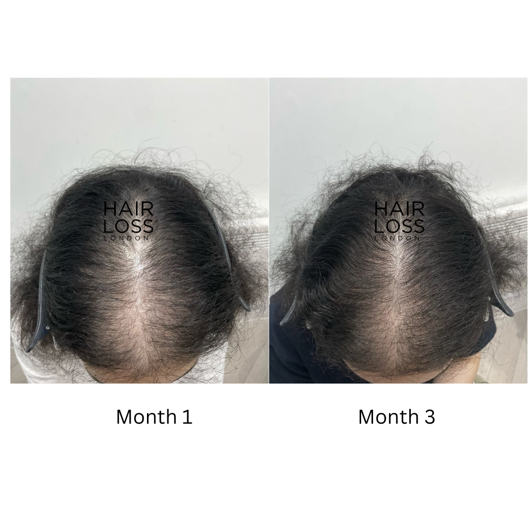 PCOS related hair loss female