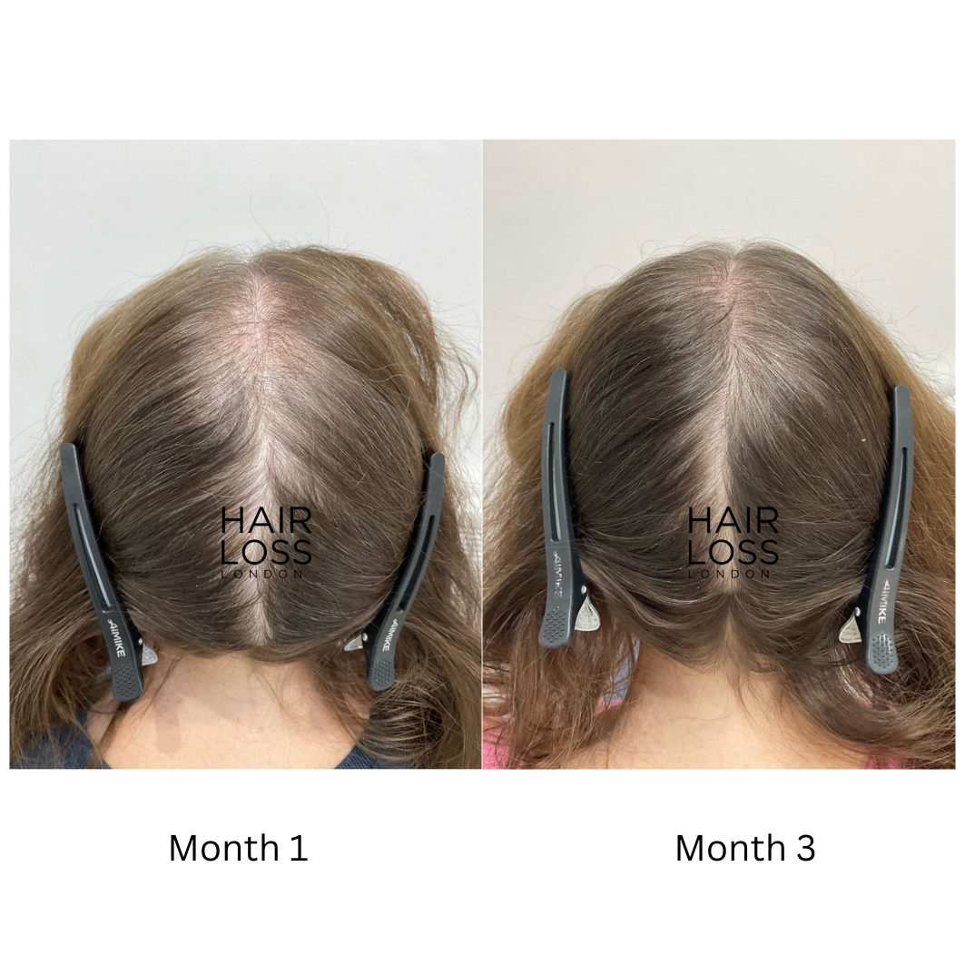 PCOS related alopecia