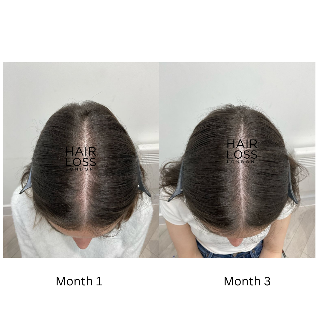 why is my hair thinning female 30s/40s/50s