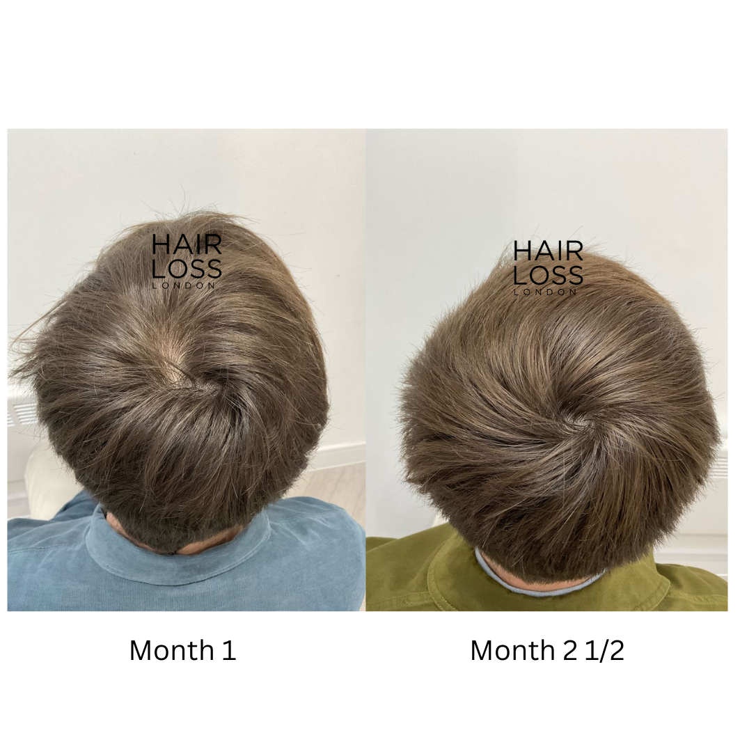 male Androgenic Alopecia