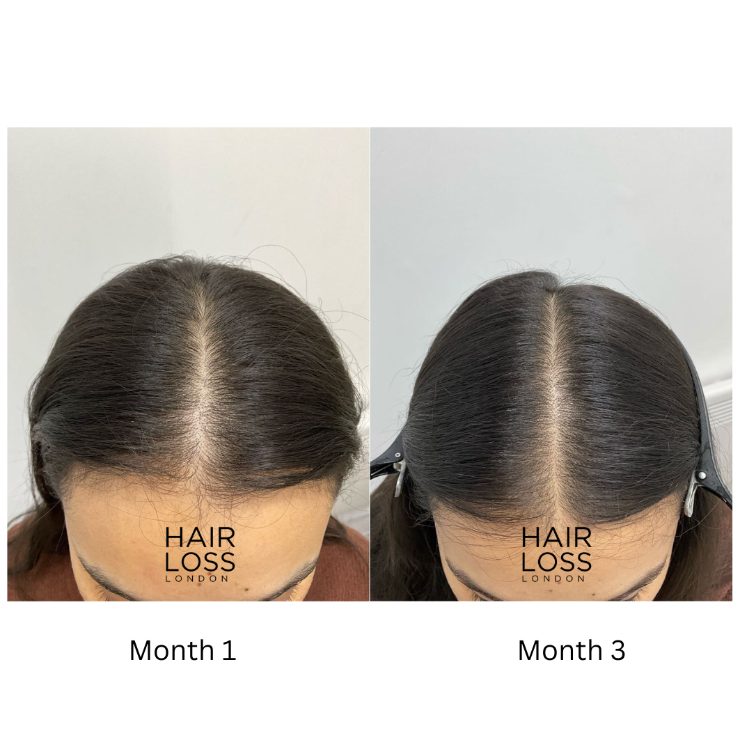 platelet-rich plasma PRP hair restoration