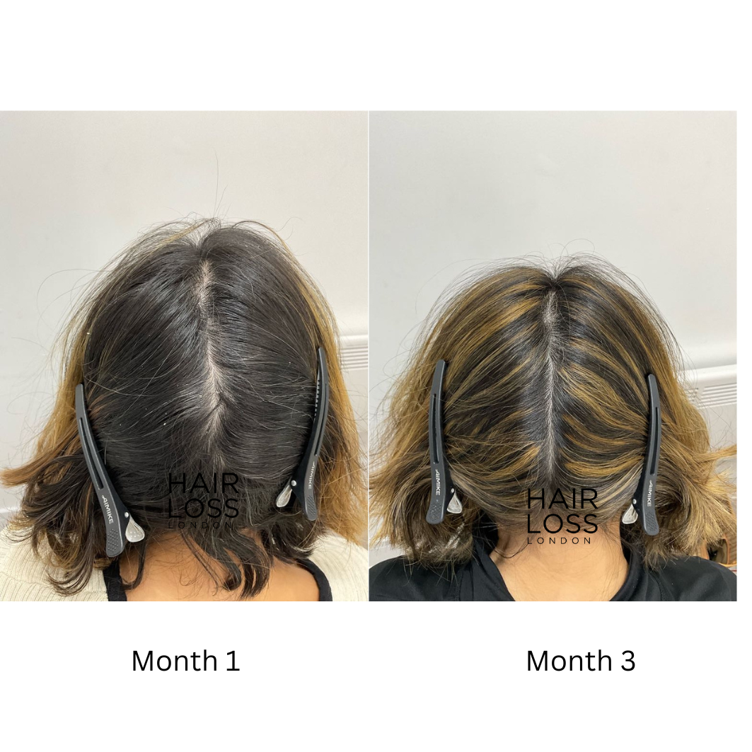 hormonal imbalance hair thinning female