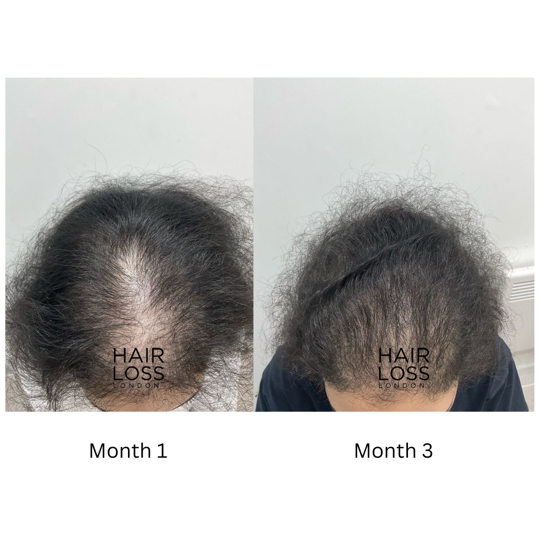 androgenetic alopecia diagnosis female