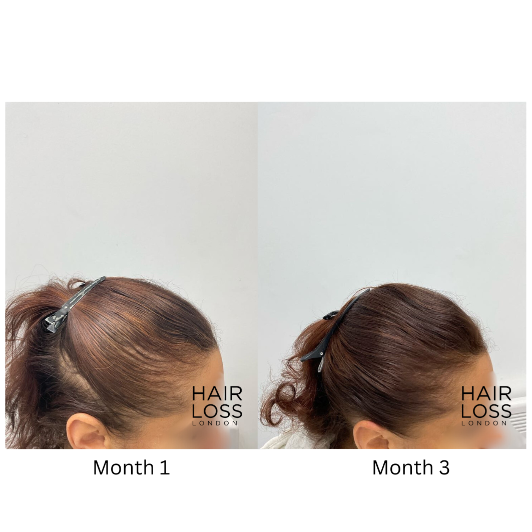 stress related telogen effluvium in women