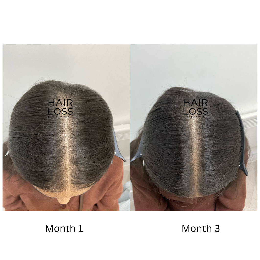 nutritional supplements for hair loss