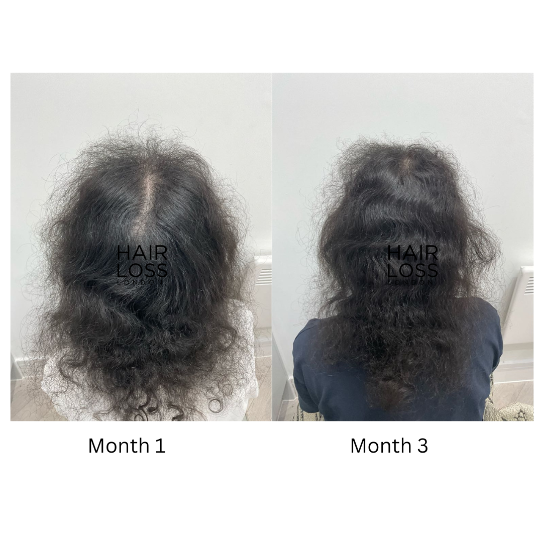 dutasteride women androgenetic alopecia