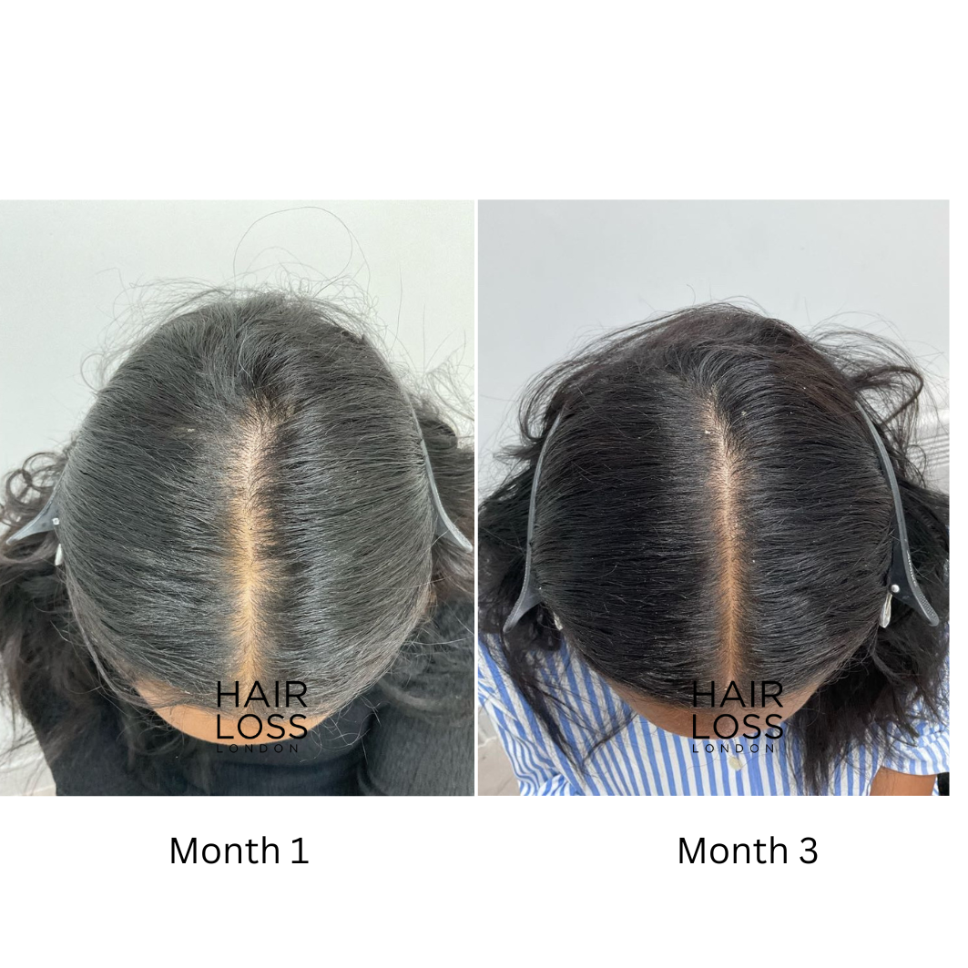 oral minoxidil low dose