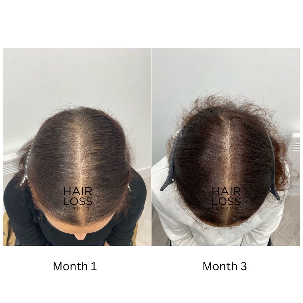 best treatments for female pattern baldness 2025