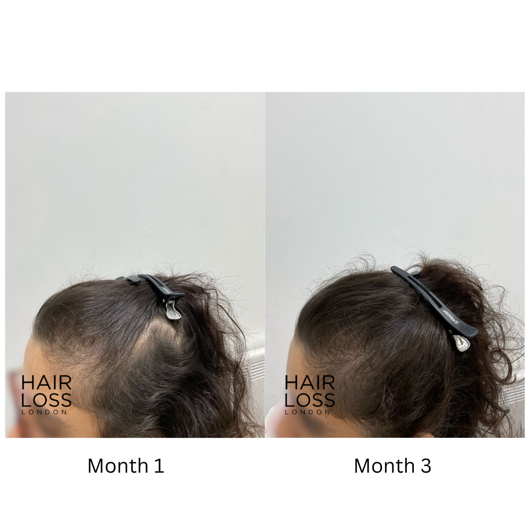 PCOS related hair loss female
