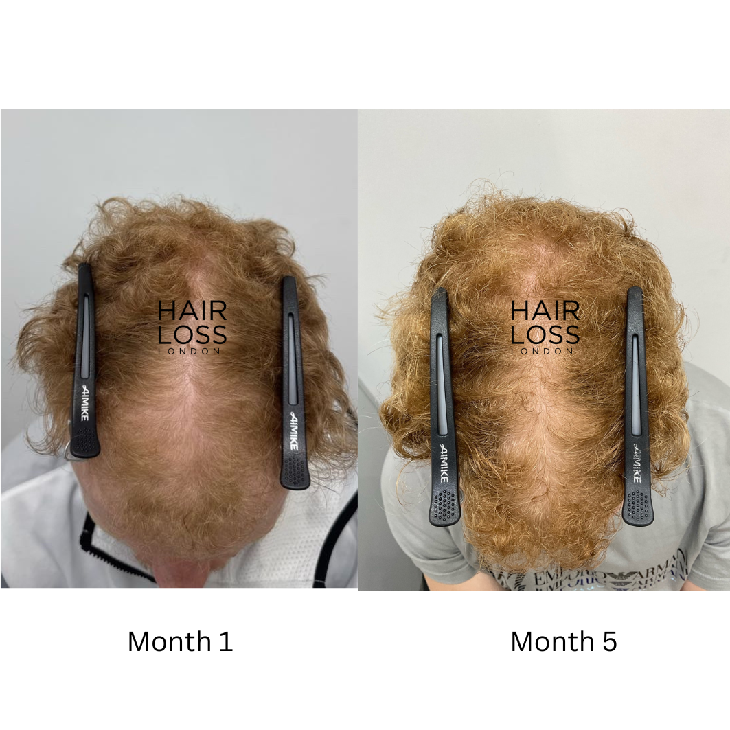 hair loss clinic London