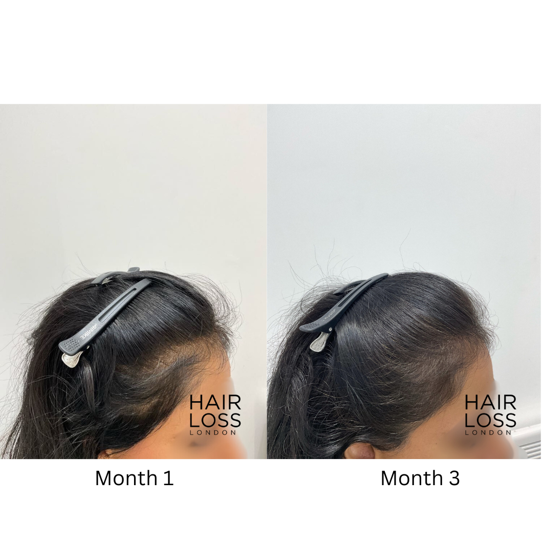 Non surgical hair loss treatment women London