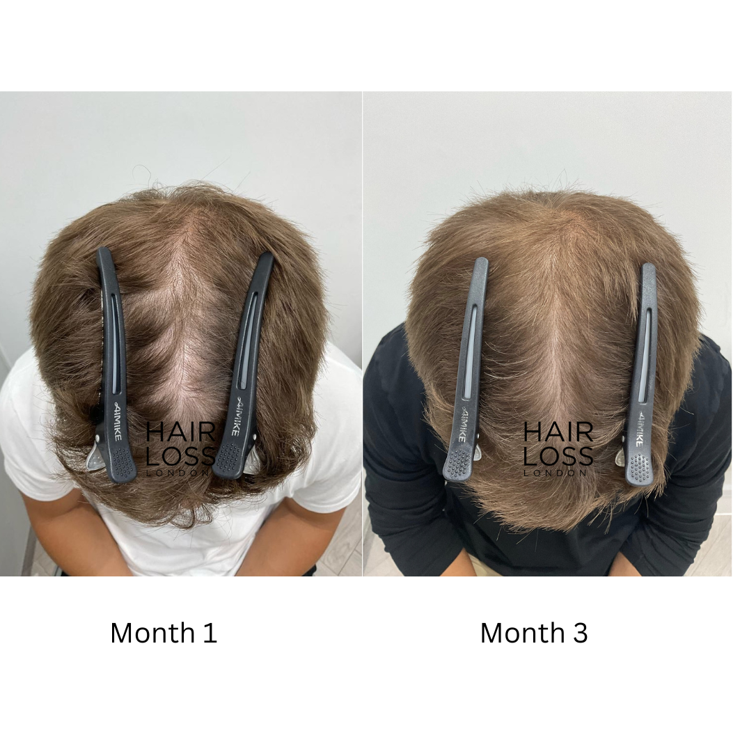 Scalp Micropigmentation (SMP) London