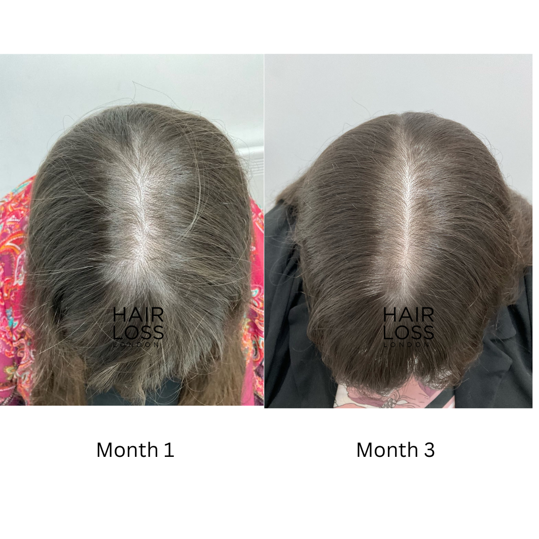 female pattern baldness