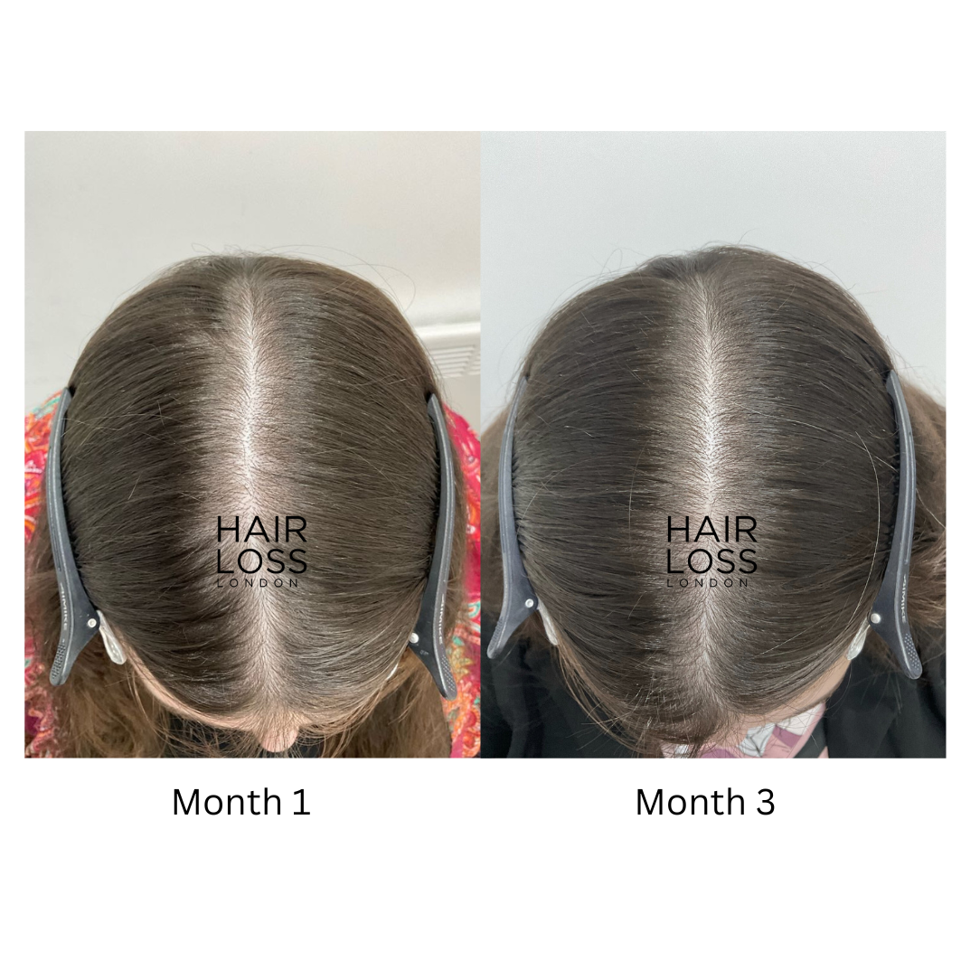 Hair and scalp clinic London for women