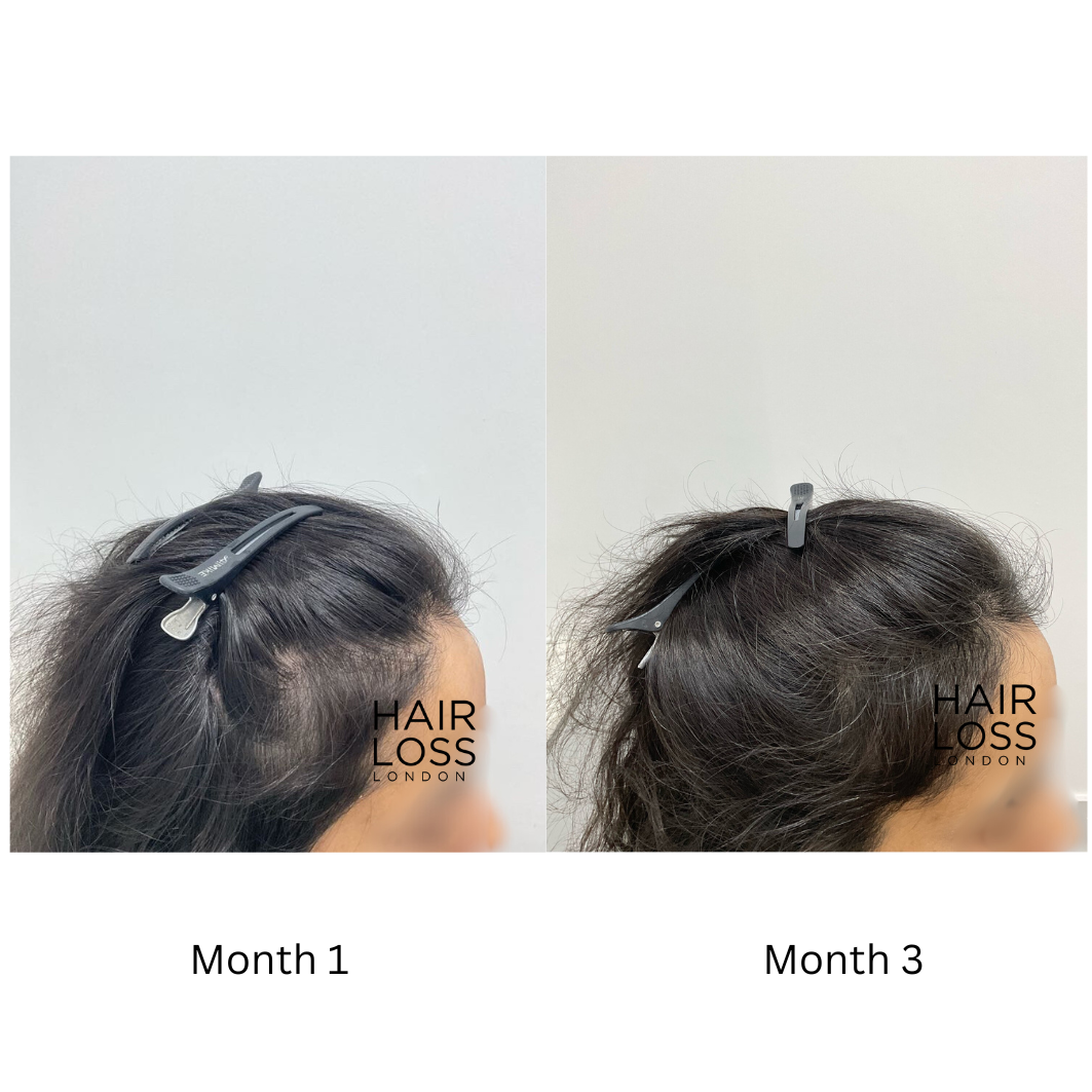 PRP hair treatment for women London
