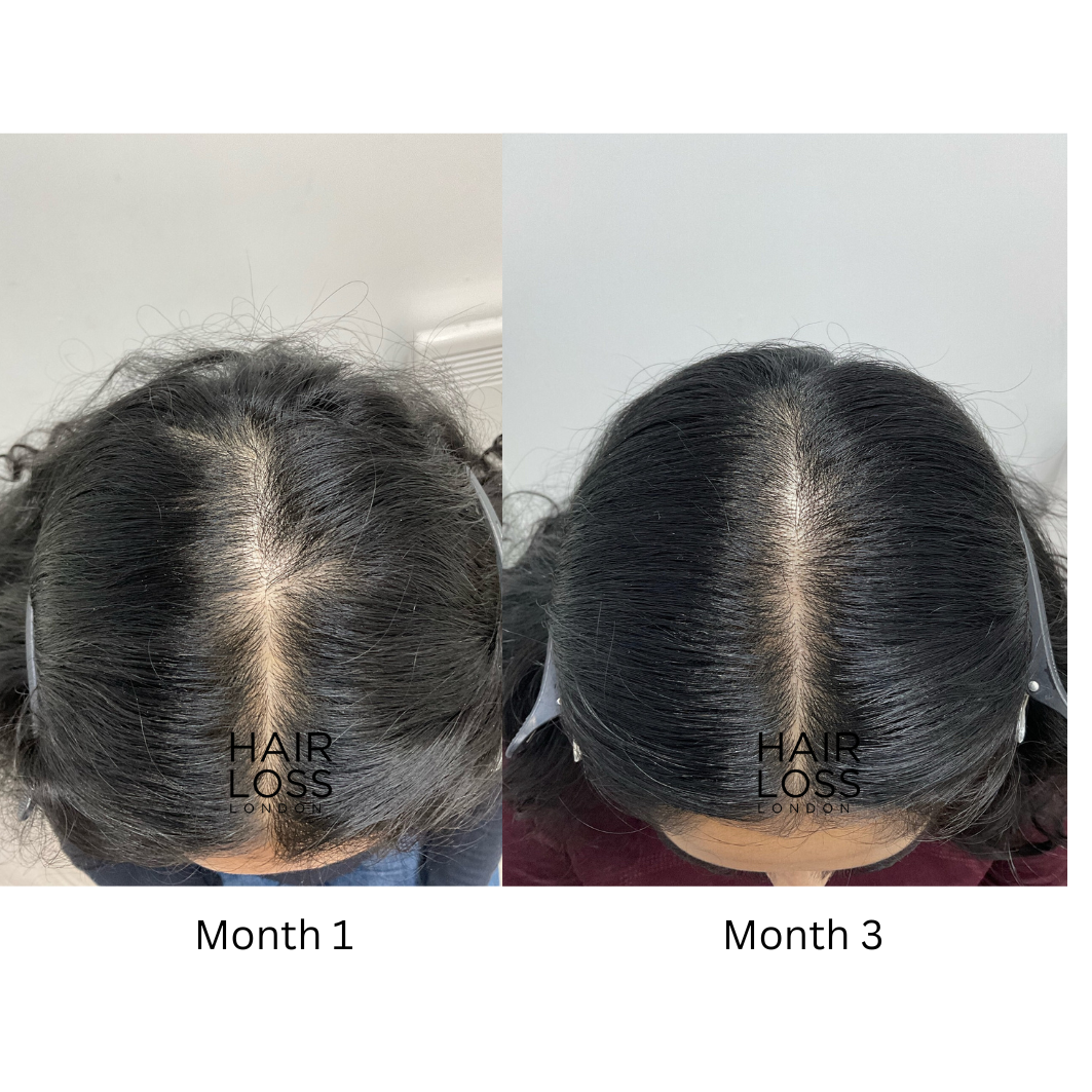 Non-surgical hair restoration for ladies London