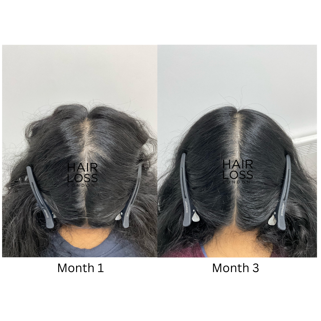 Bespoke hair replacement systems for women London