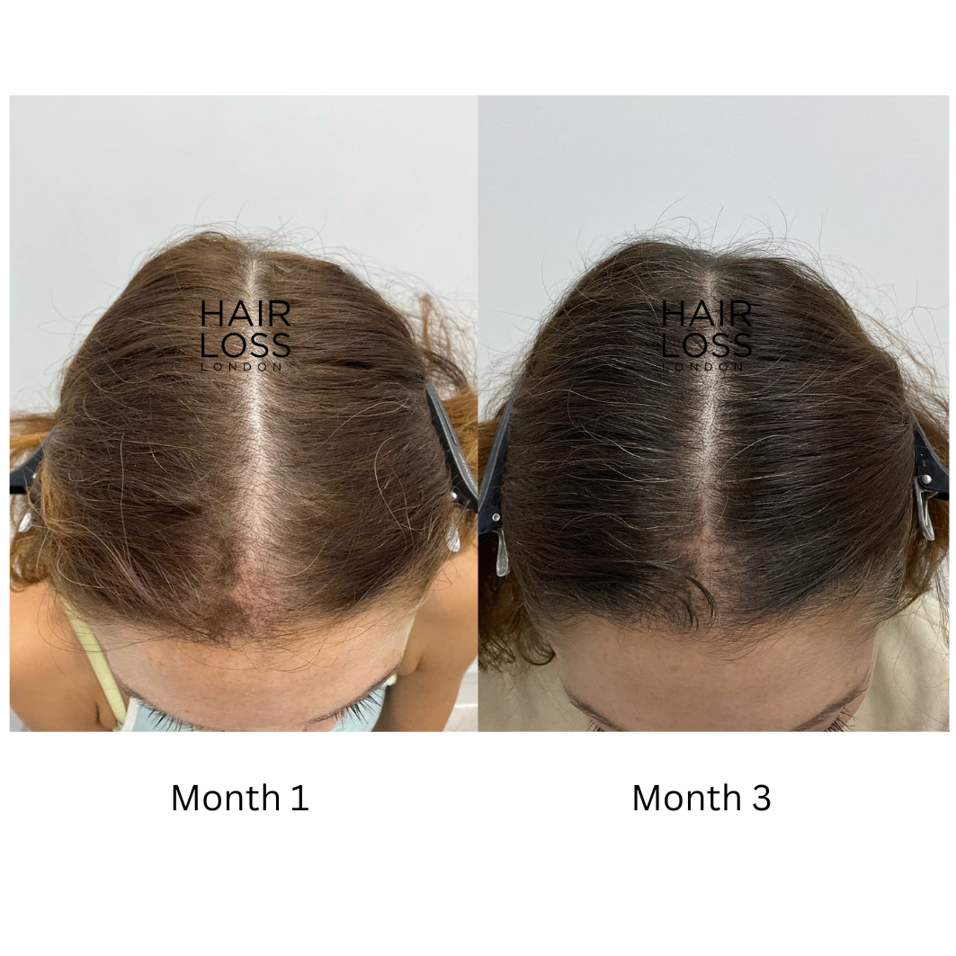 Female FUE hair transplant London 2026 reviews