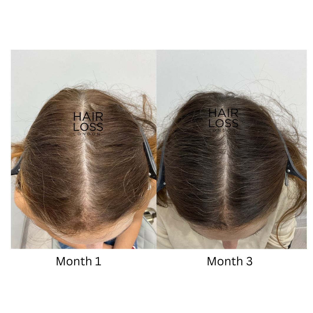 Holistic female hair regrowth treatment London