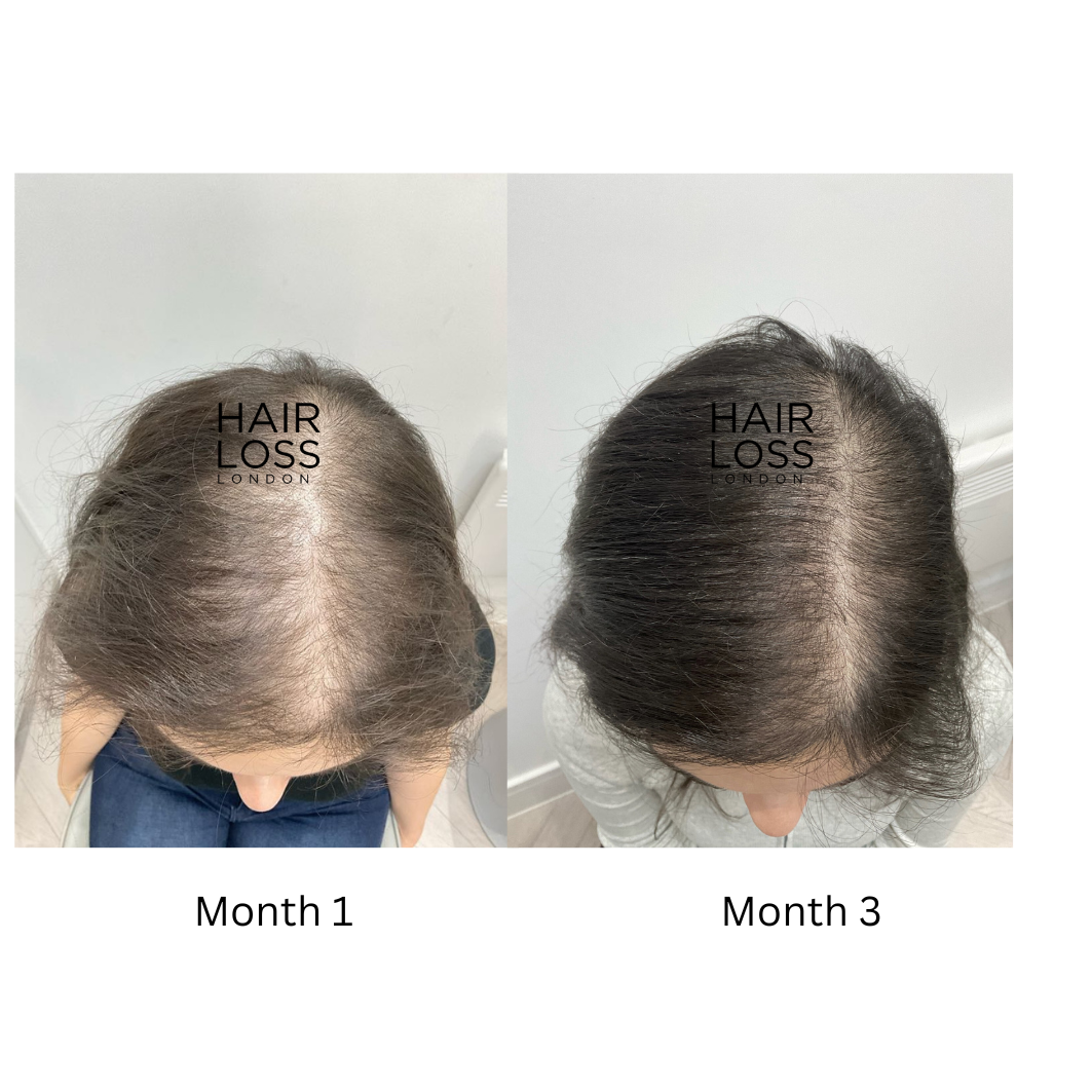 Best hair clinic for women London