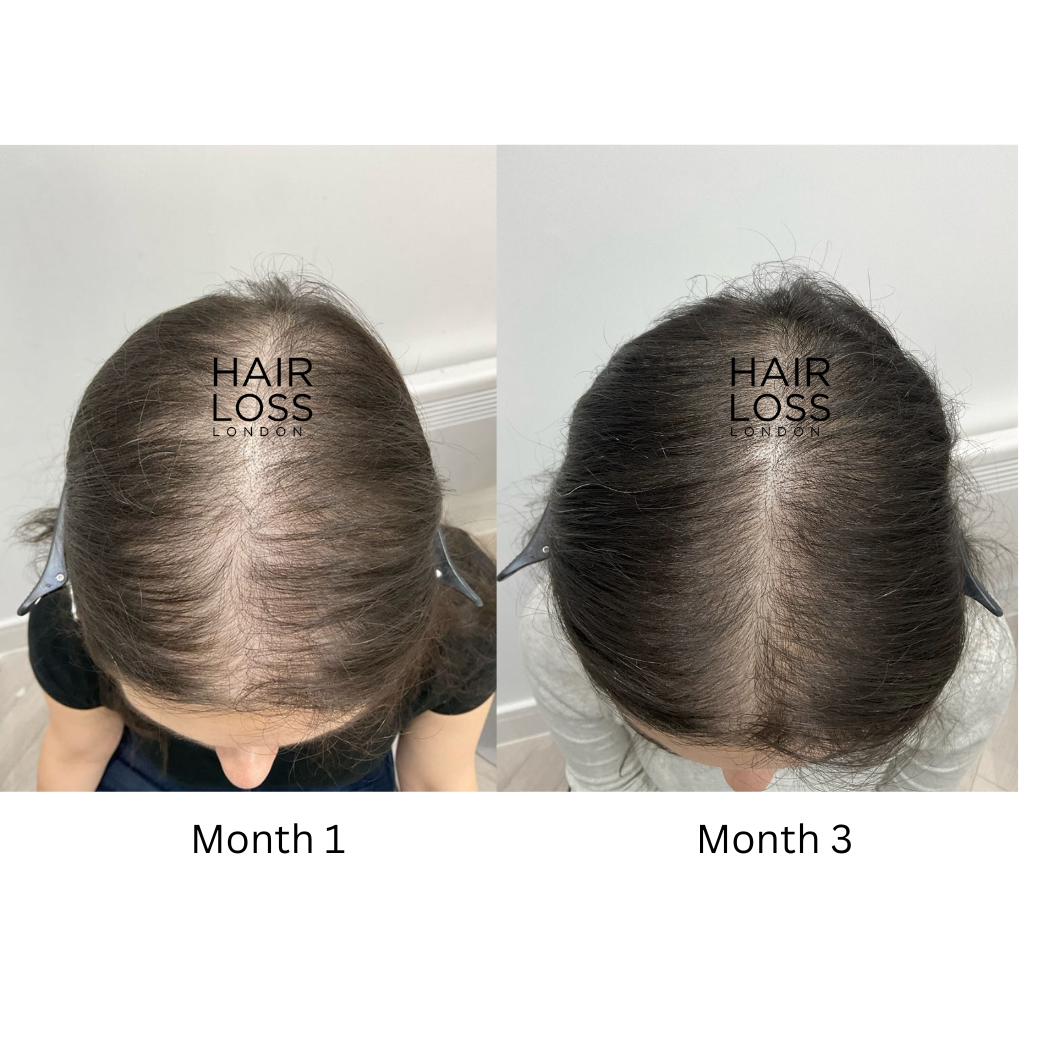 Female pattern hair loss specialist London