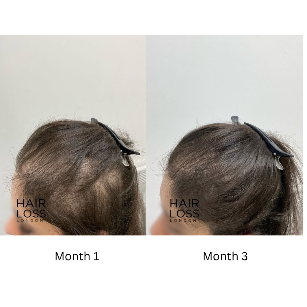 Female pattern baldness treatment London