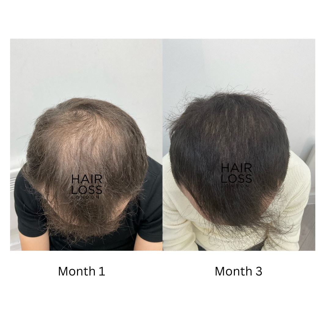PRP therapy for thinning hair London