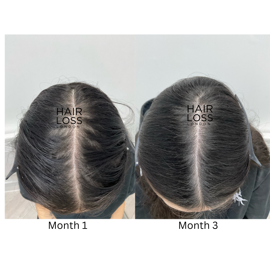 PCOS hair loss treatment clinic London