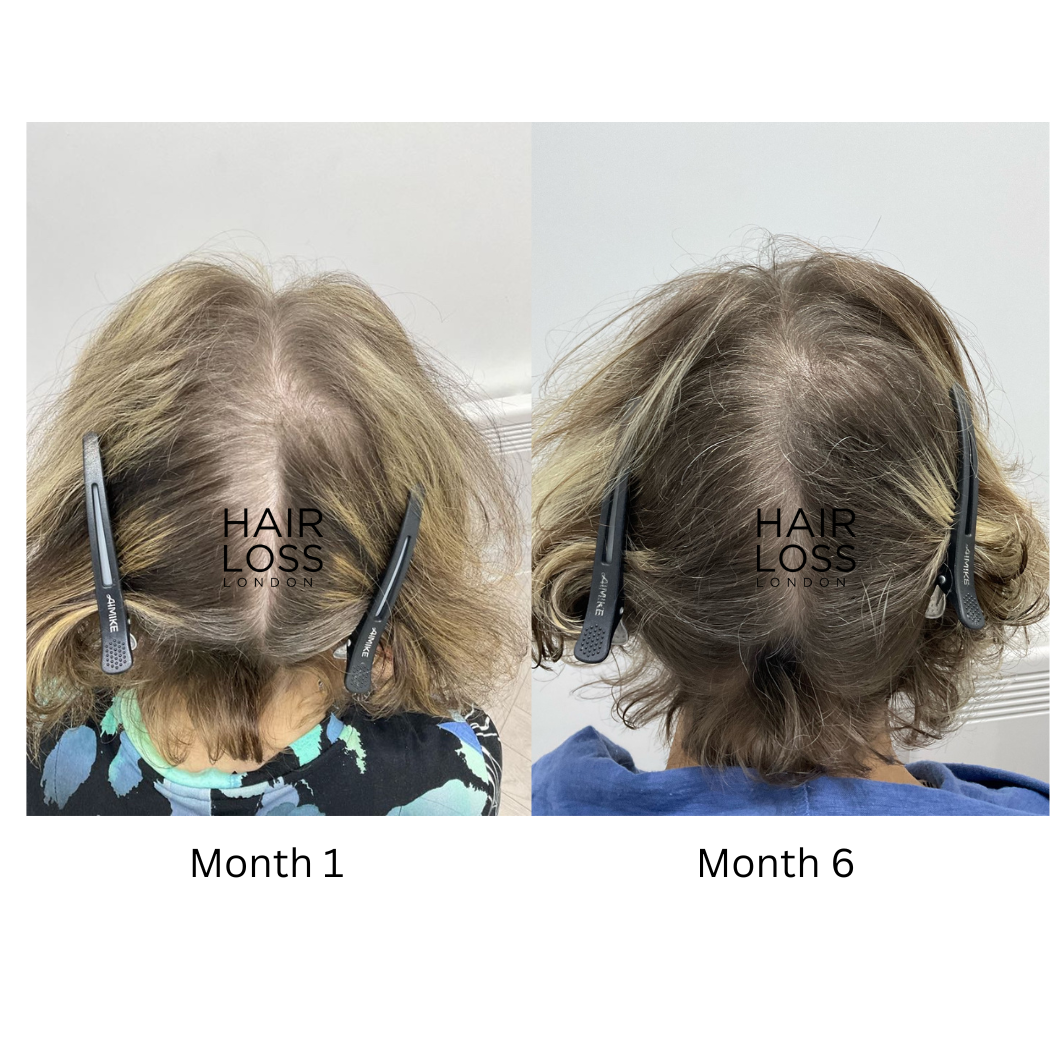 Telogen effluvium treatment London