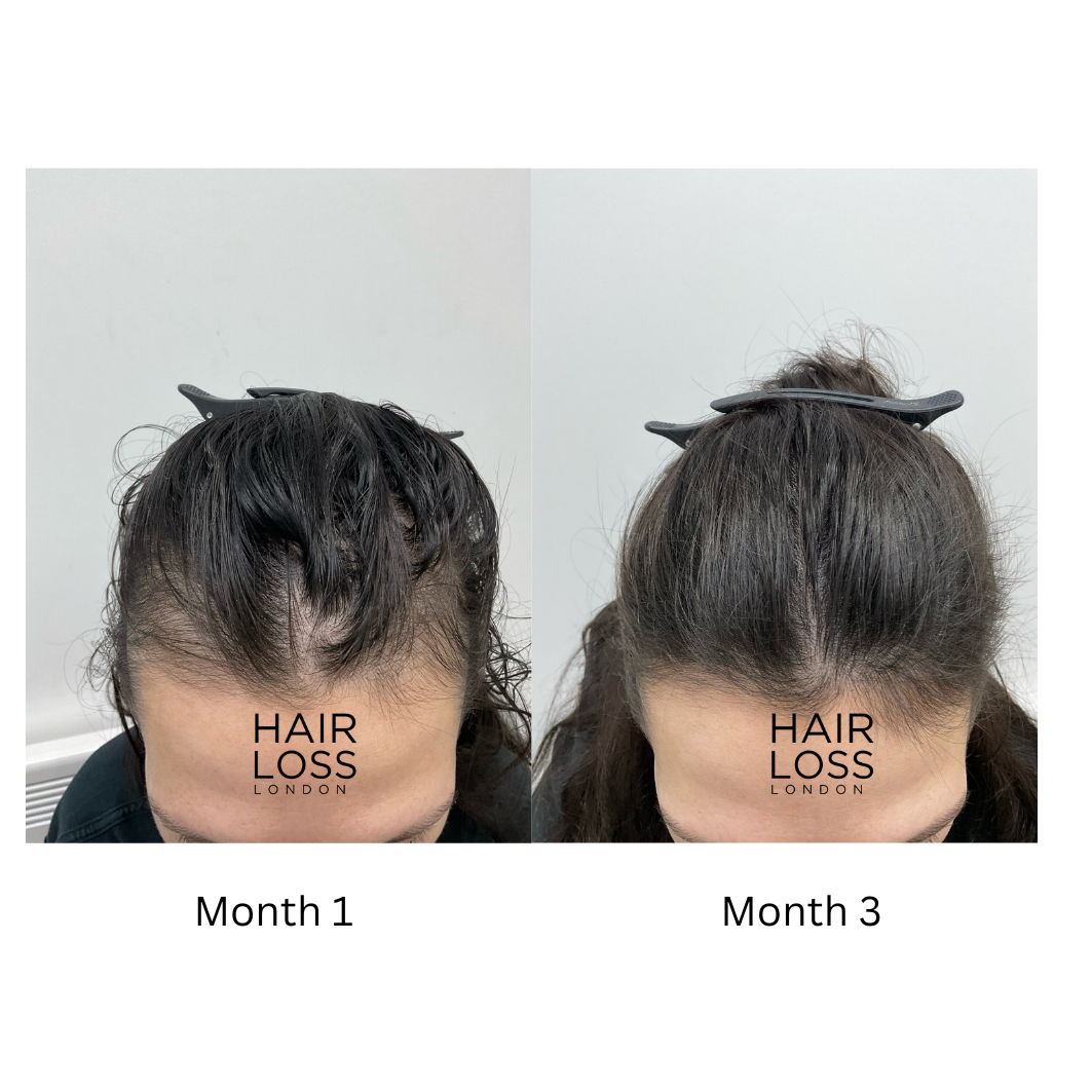 Female hair loss clinic London