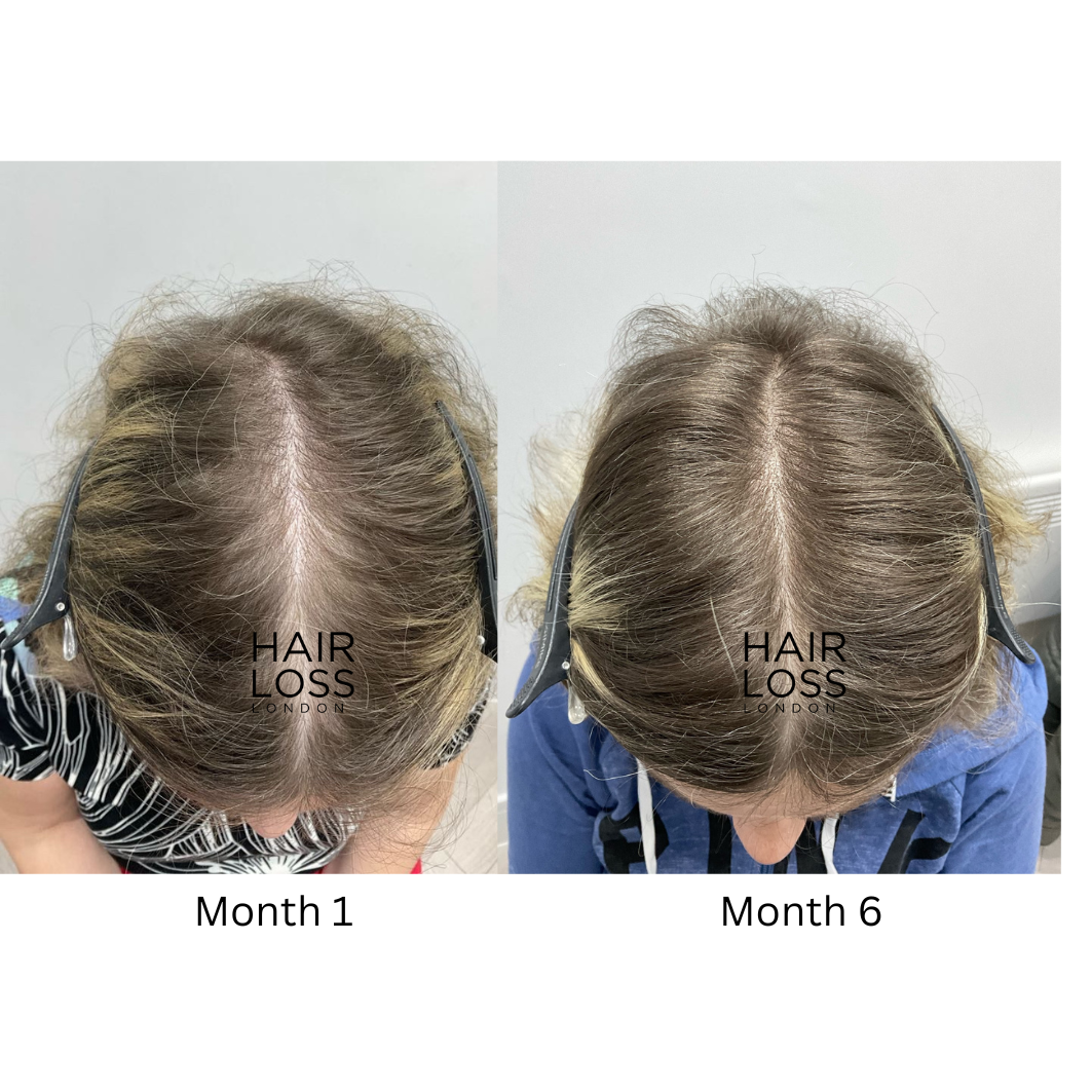 PRP hair loss treatment for women London prices
