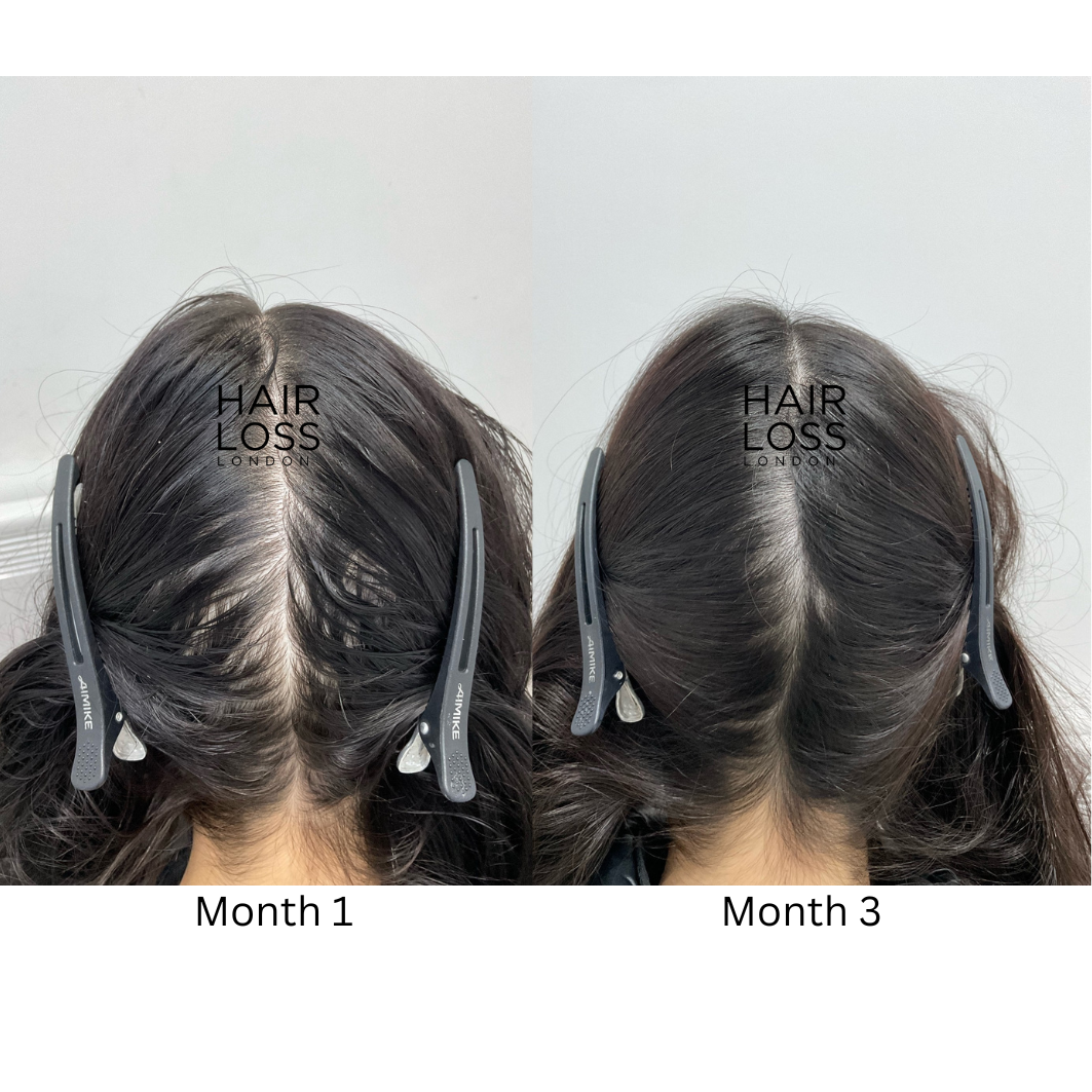 Hair thinning solutions for women London