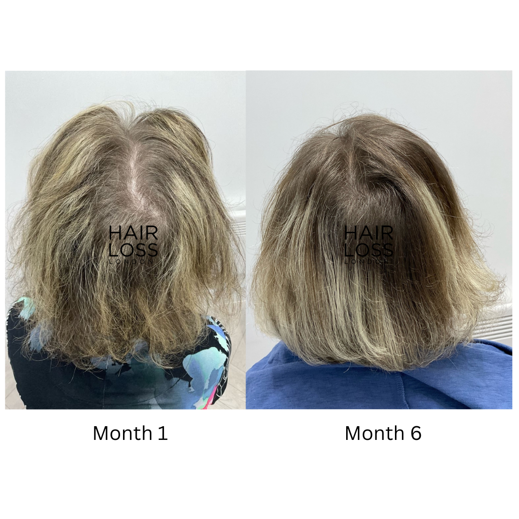 Hormonal hair thinning clinic London 2026
