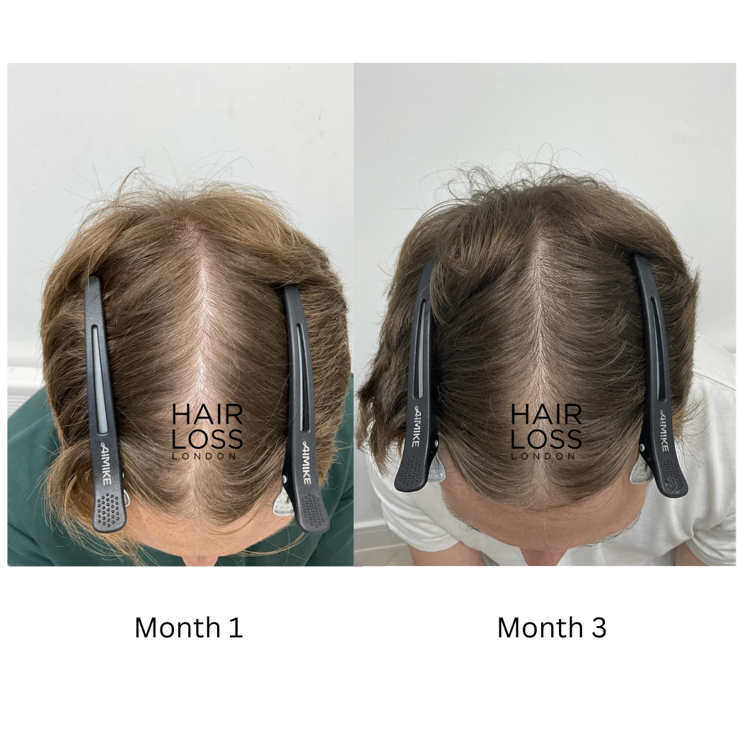 Advanced DHI hair transplant London