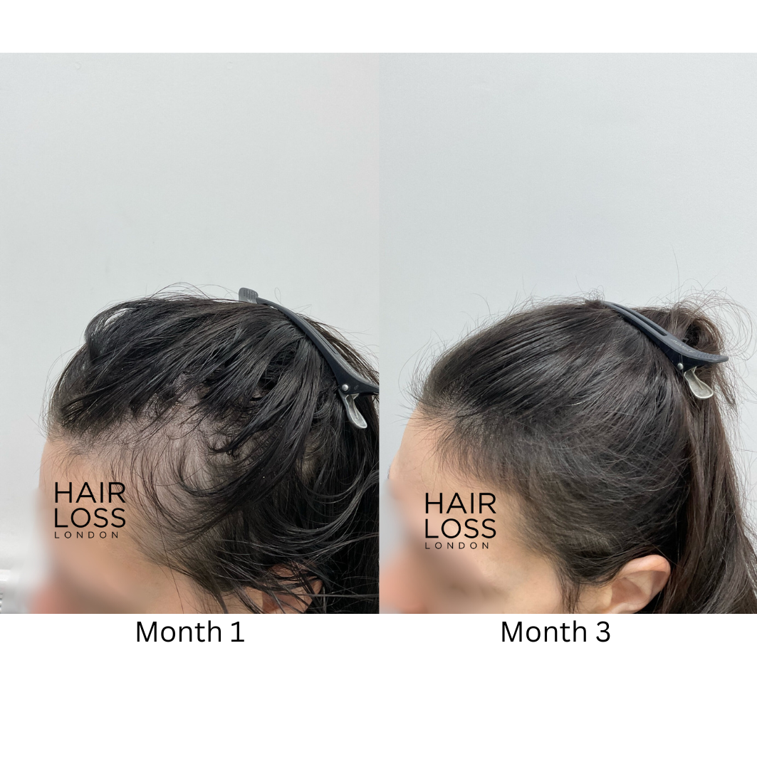Androgenetic alopecia treatment women London