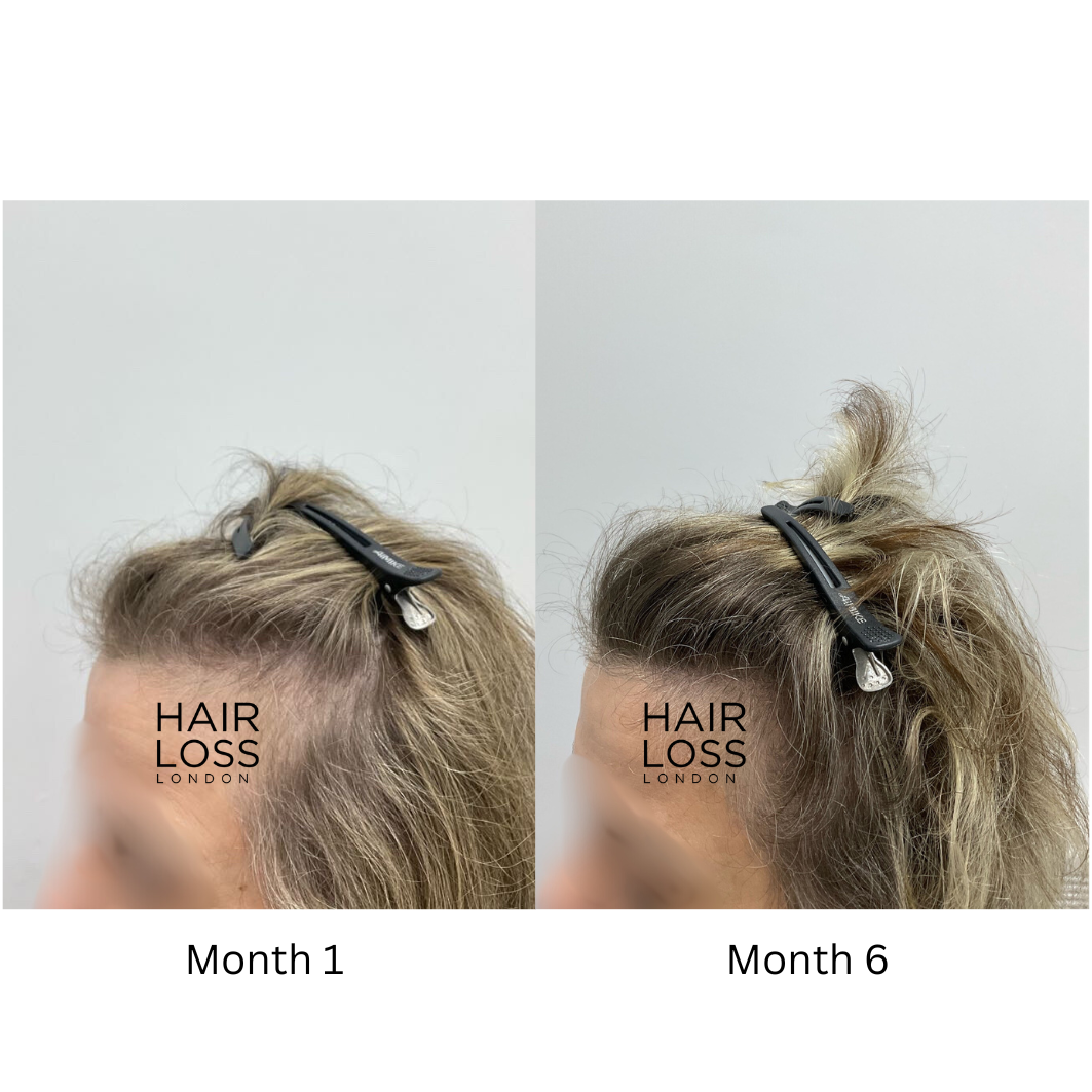 Hair loss treatment for women London
