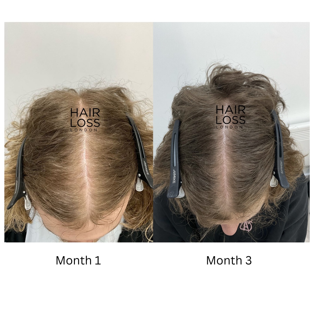 Consultant Dermatologist hair loss London