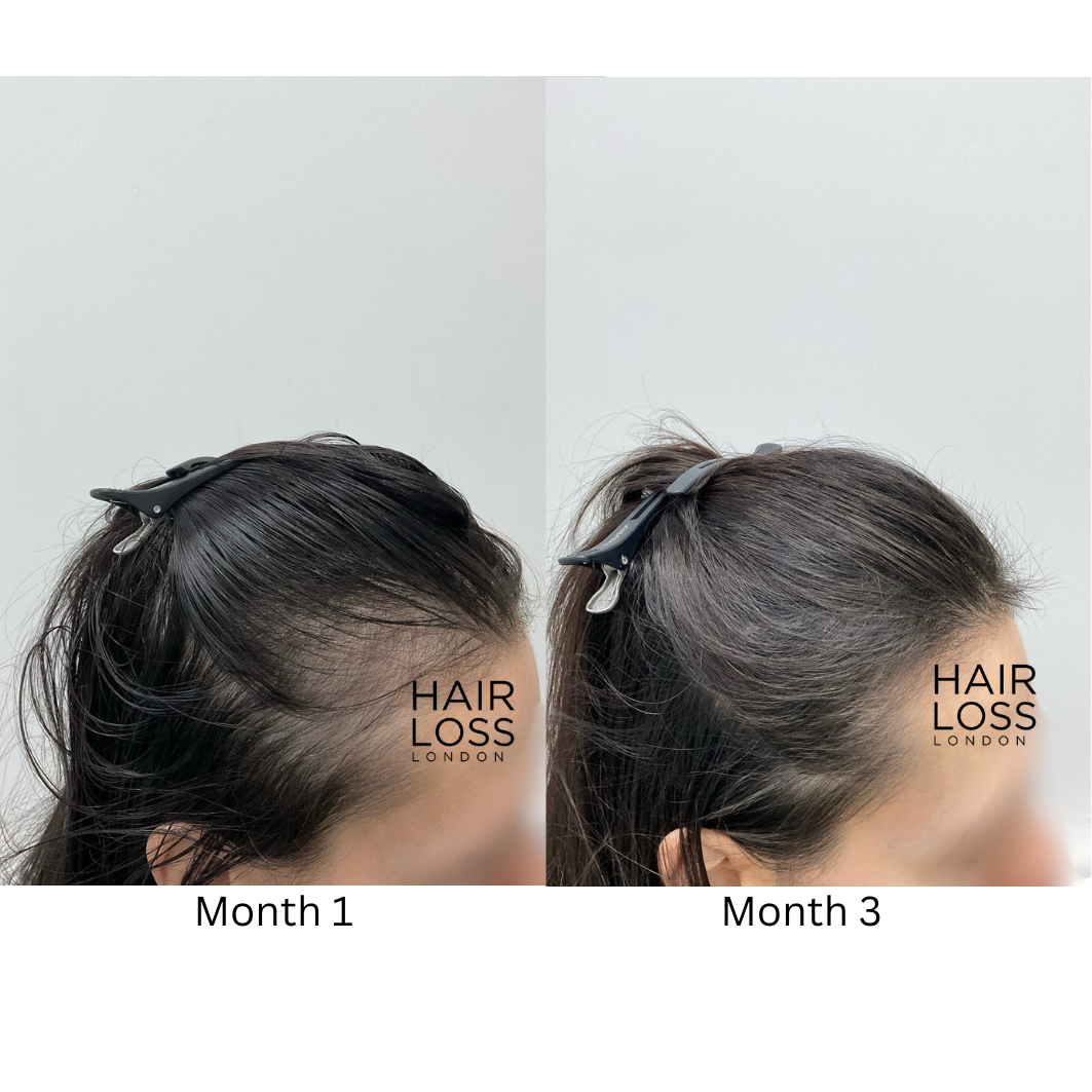 Consultant dermatologist female hair loss London Harley Street