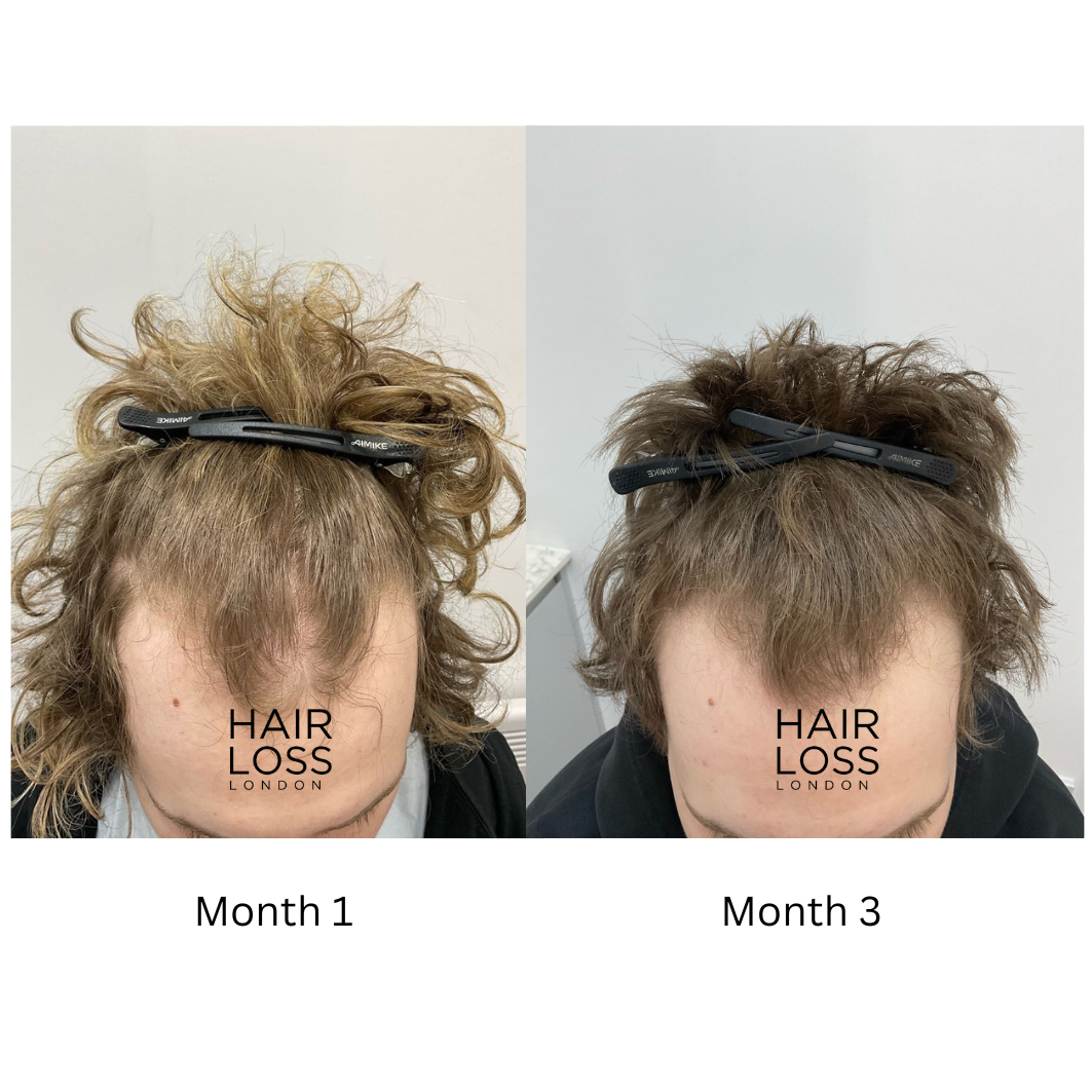 Trichologist London hair and scalp specialist