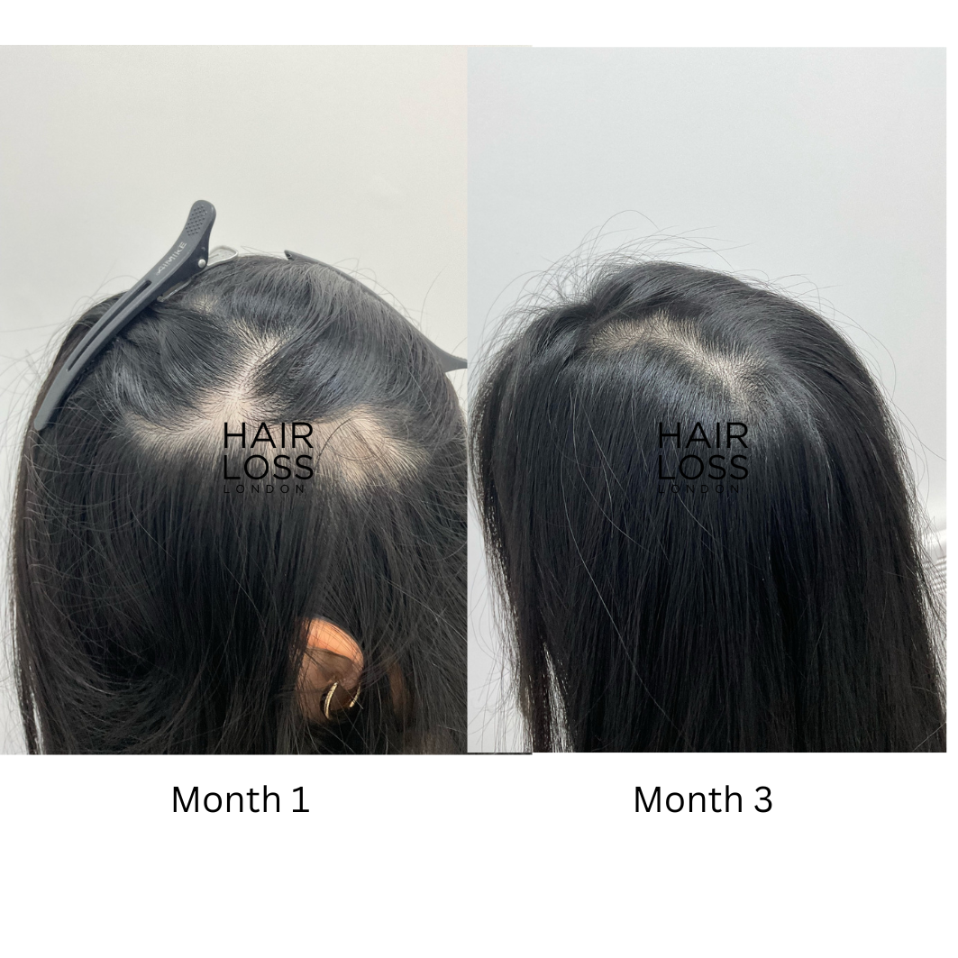 Alopecia Areata